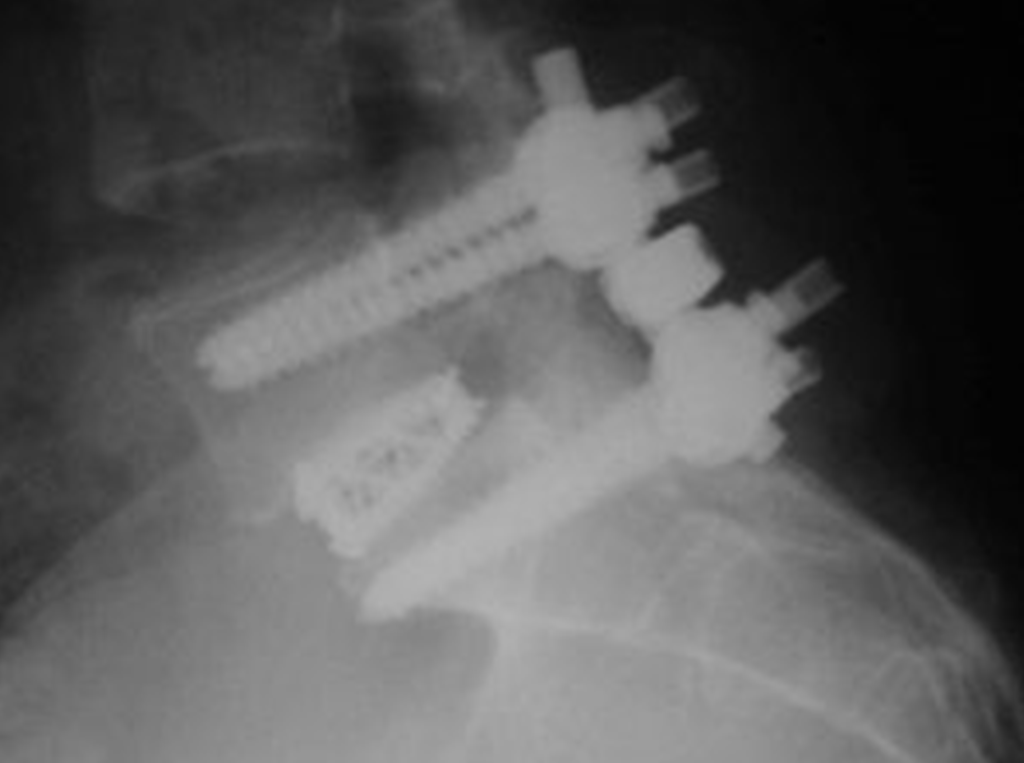 Artificial Lumbar Disc Surgery Reno Orthopedic Center