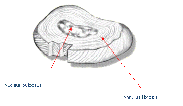 Preop MRI scan showing spinal stenosis secondary to facet joint arthrosis and ligamentous hypertrophy at the L45 level.