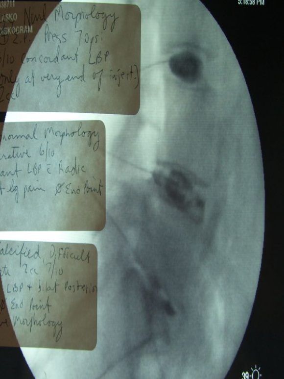 Anterior Lumbar Interbody Fusion (ALIF) Surgery | ROC