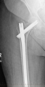 An x-ray image of a post-operative hip fracture