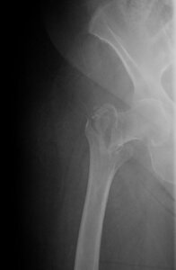 An x-ray image of a hip fracture