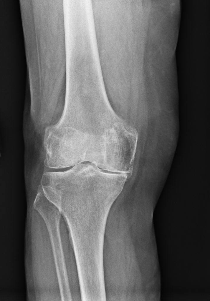 Knee Arthritis Diagnosis & Treatment ROC