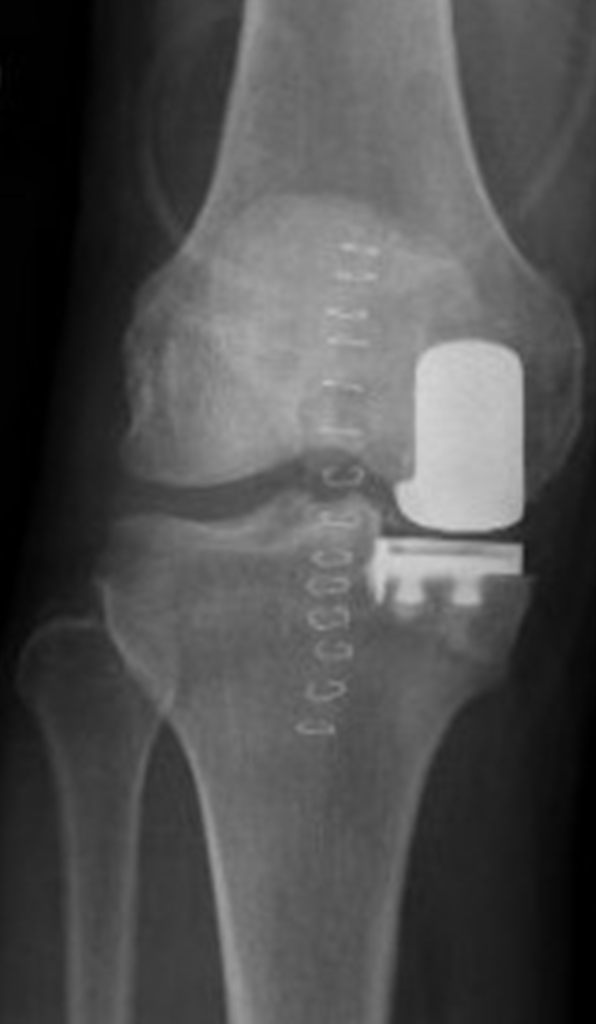 Partial Knee Replacement Reno Orthopedic Center