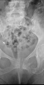 Broken Pelvic Bone X-Ray