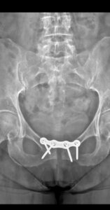 Post-Operative X-Ray of Pelvic Fracture Surgery
