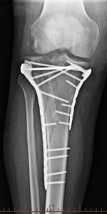 An x-ray image of a Post-Op Tibial Plateau Fracture
