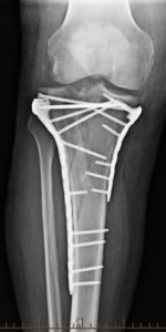 Broken Leg: If my tibial shaft fracture gets surgery, when can I