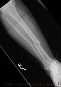An x-ray image of a tibial shaft fracture