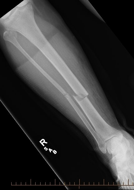 Broken Tibia | Tibial Shaft Fracture Diagnosis & Treatments | ROC