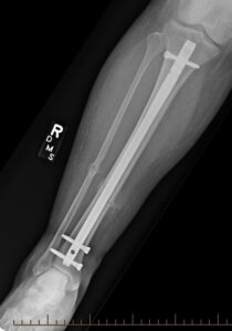 A post-op x-ray of a tibial shaft fracture.