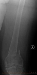 An X-Ray of a Distal Femur Fracture