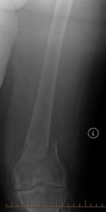 An X-Ray of a Distal Femur Fracture