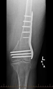An x-ray of a post-op distal femur