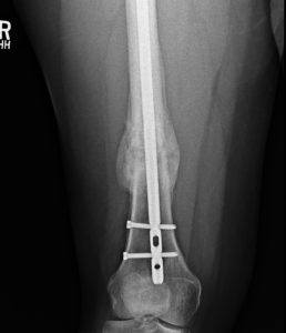 Post-op X-Ray of Femoral Shaft Fracture Surgery