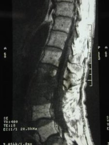 Immediate postoperative CT scan showing the extent of bone and ligament removal.