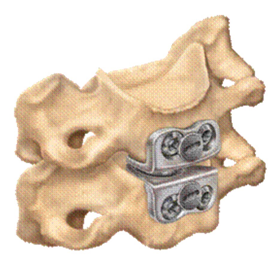 Имплант шейного отдела позвоночника