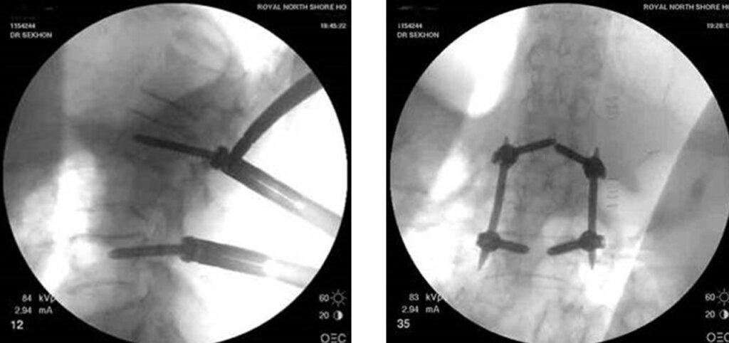 Spinal Injections | Purpose, Types & Procedure | ROC