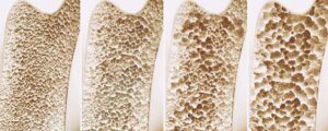 A set of photos showing more and more degrading of the bone due to the effects of worsening Osteoporosis.