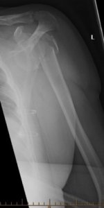 Proximal Humerus Fracture X-Ray