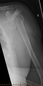 Proximal Humerus Fracture (Broken Humerus) | Reno Orthopedic Center