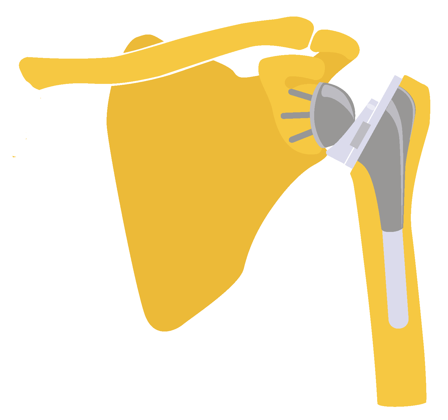 Shoulder Replacement Reno, Sparks, Carson City ROC