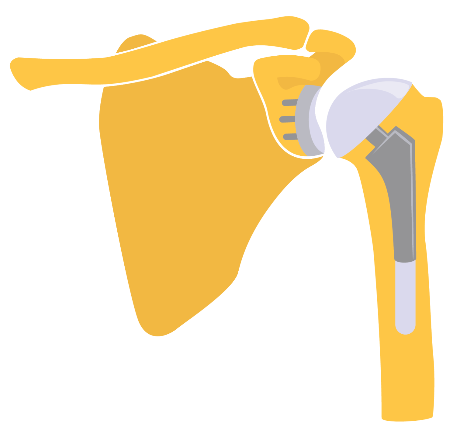 Shoulder Replacement Reno, Sparks, Carson City ROC