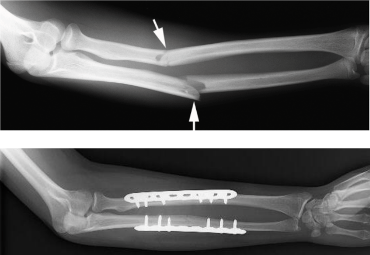 Forearm (Radius and Ulna) Fractures Reno Orthopedic Center